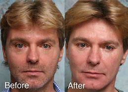 Image result for botched plastic surgery eyes