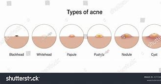 Image result for Pustules and Papules On Face