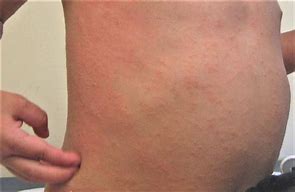 Image result for Diagnose Skin Rash