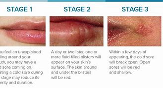 Image result for Cold Sore Marks