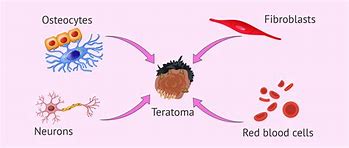 Image result for Teratoma Hair