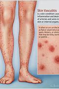 Image result for Vasculitis Signs