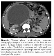 Image result for Retrocaval Cyst