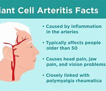 Image result for Giant Cell Temporal Arteritis