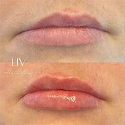 Image result for Versa Lip Filler