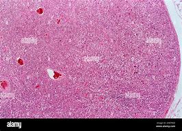 Image result for Mycobacterium Avium Infection