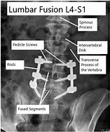 Image result for Lumbosacral Fusion