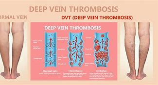 Image result for Thrombotic Veins