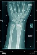 Image result for Thumb X-ray Child