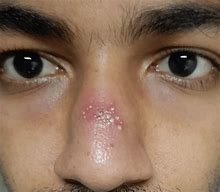 Image result for Pustules On Nose