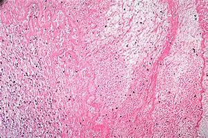 Image result for Sessile Thrombus