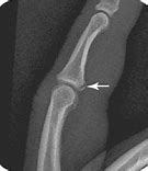 Image result for Volar Fracture