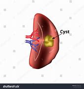 Image result for Cyst On Spleen