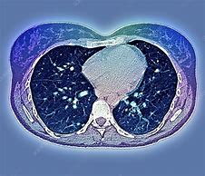 Image result for Lung Cancer On CT