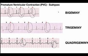 Image result for Premature Atrial Contraction