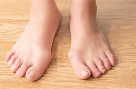 Image result for Rheumatoid Arthritis Nodules On Feet