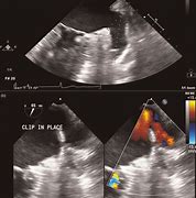 Image result for Thoracoscopic Left Atrial Appendage Clipping