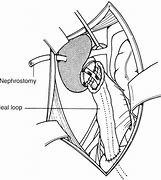 Image result for Long Tunnel Ureter