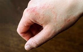 Image result for Eczema Rash On Hands