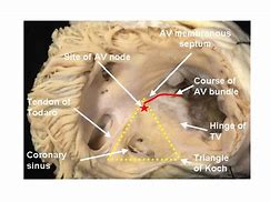 Image result for Atrioventricular Septum