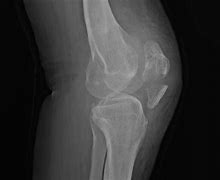 Image result for Ottawa Knee