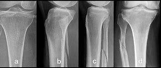 Image result for Deformity of Fibular Head