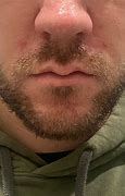 Image result for Pustules On Nose