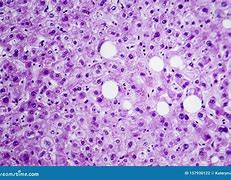 Image result for Swelling of Liver