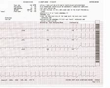 Image result for Atrial Fibrillation 12 Lead ECG