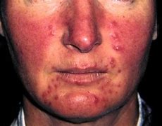 Image result for Pustule Pimple