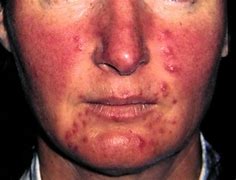 Image result for Pustule Skin Lesion