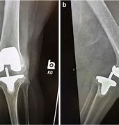 Image result for Left Knee Arthroplasty