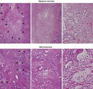 Image result for Necrosis Histology