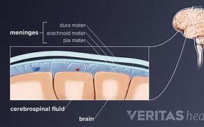 Image result for Meningitis Neck Pain