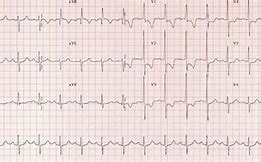 Image result for Right Ventricular Hypertrophy