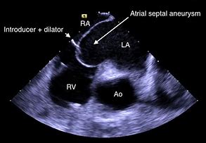 Image result for Septal Aneurysm