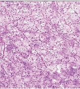 Image result for Myxoid Liposarcoma