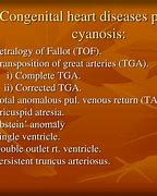 Image result for Cyanotic Heart Defect