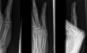 Image result for Volar Fracture