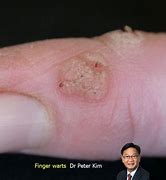 Image result for Filiform Wart On Finger