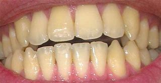 Image result for Teeth with Yellow Stuff