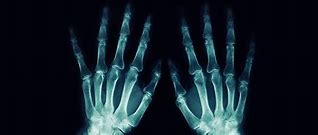 Image result for Ra Hand X-ray