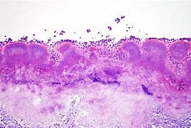 Image result for Actinomycetoma