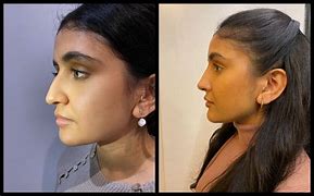 Image result for Bad Nose Jobs