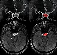 Image result for Aneurysm in MRI