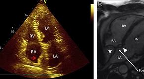 Image result for Interatrial Septum Lipomatous Hypertrophy Echo