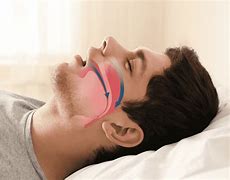 Image result for Obstructive Sleep Apnea Machine