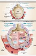 Image result for Acute Pulmonary Oedema Positioning