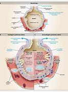 Image result for Acute Lung Oedema