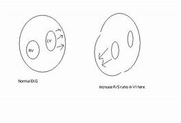 Image result for RVH ECG